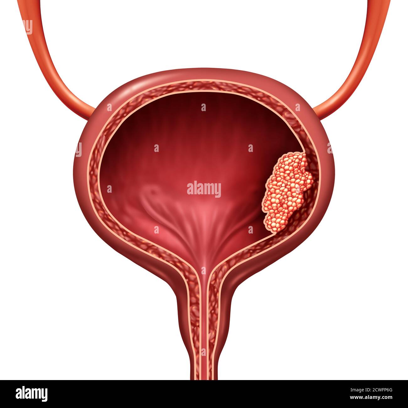 Cancro della vescica umana come una malattia dell'organo anatomico urinario e concetto delle cellule maligne come illustrazione 3D tagliata dell'anatomia del corpo. Foto Stock