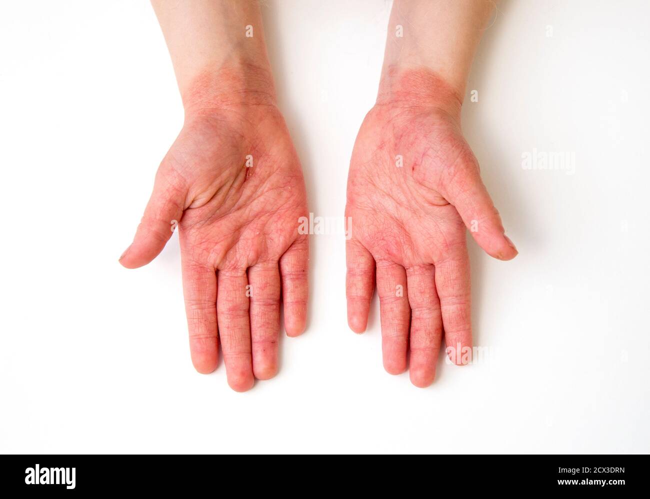 Dermatitis hand immagini e fotografie stock ad alta risoluzione - Alamy