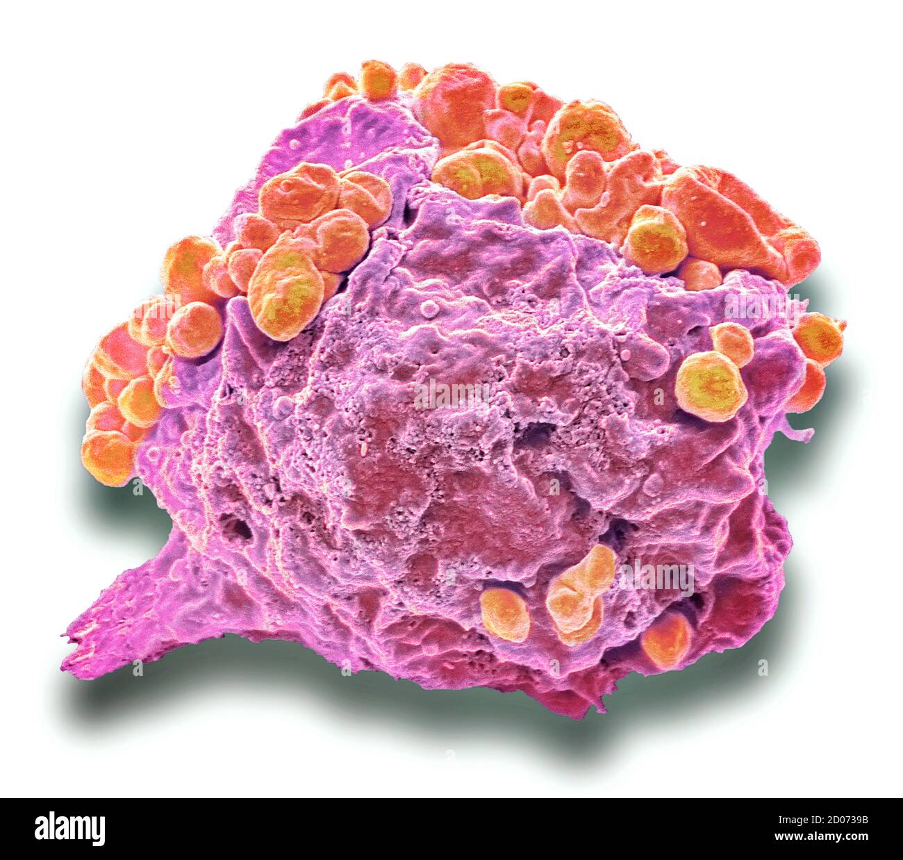 Linfoma di cellule di cancro. Color scanning electron microfotografia (SEM) di una cellula di linfoma che mostra in apoptosi precoce modifiche. Un linfoma è una cella di immu Foto Stock