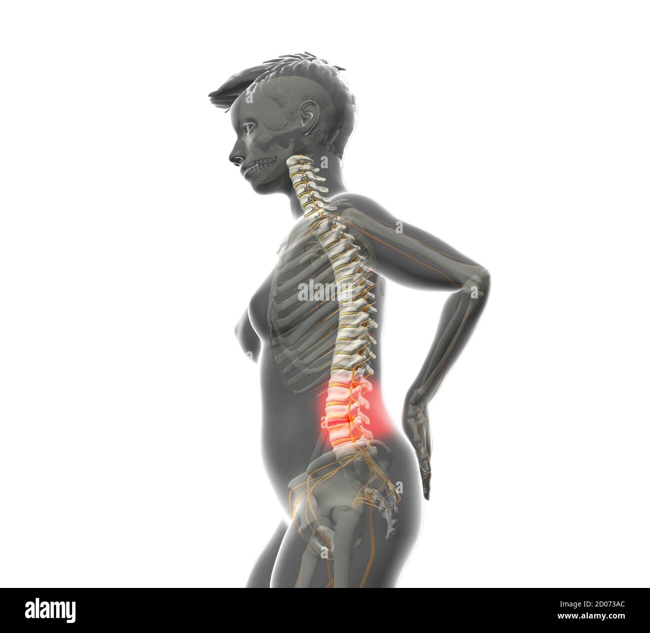 Illustrazione di una colonna vertebrale umana con un disco prolasso (o scivolato). Questa condizione si verifica quando un disco intervertebrale (giallo) viene compattato o rotto Foto Stock