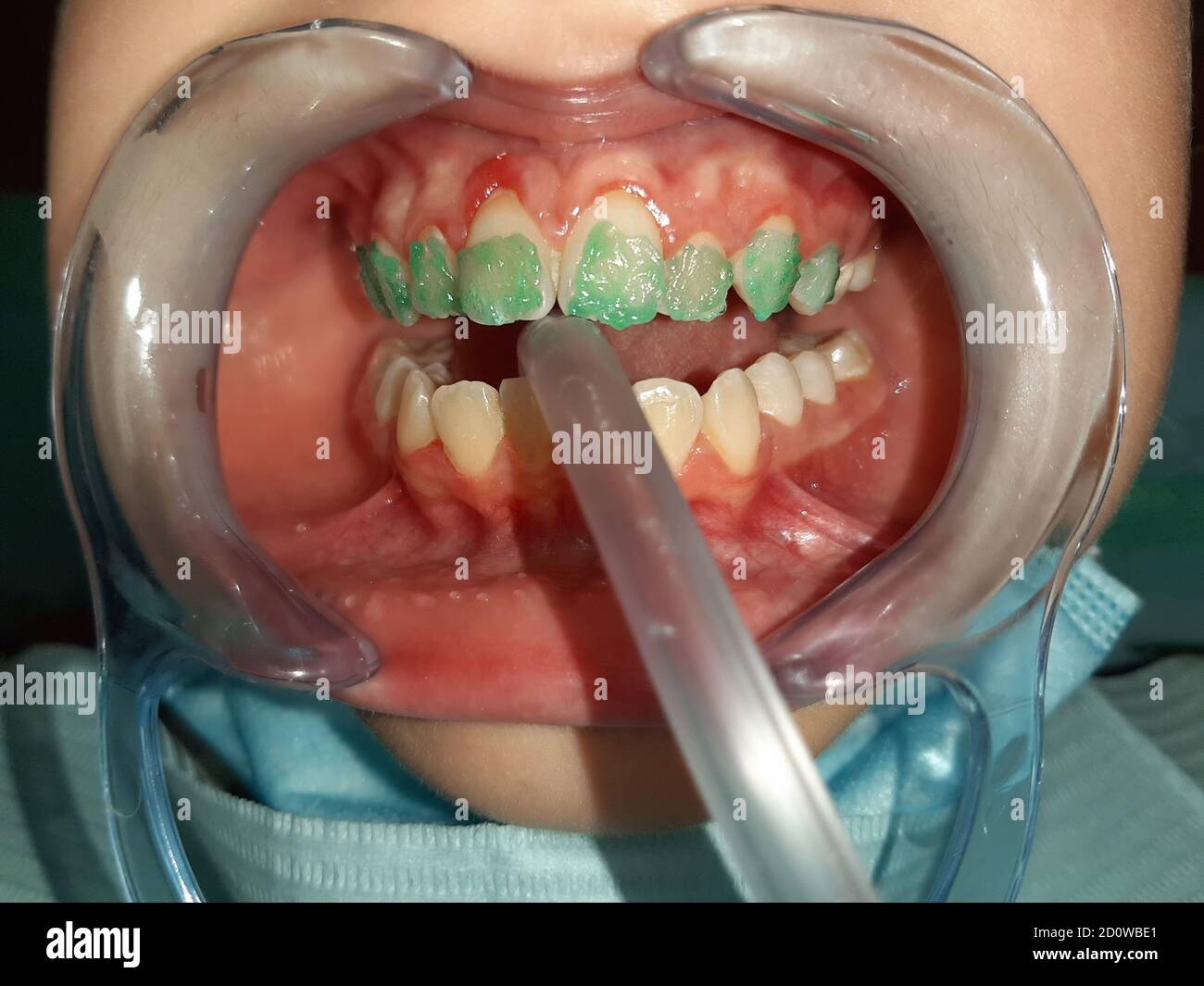 Bambina seduta su sedia dentale con closeup a bocca aperta durante la procedura per applicare i rinforzi ai denti. Dentista in visita Foto Stock