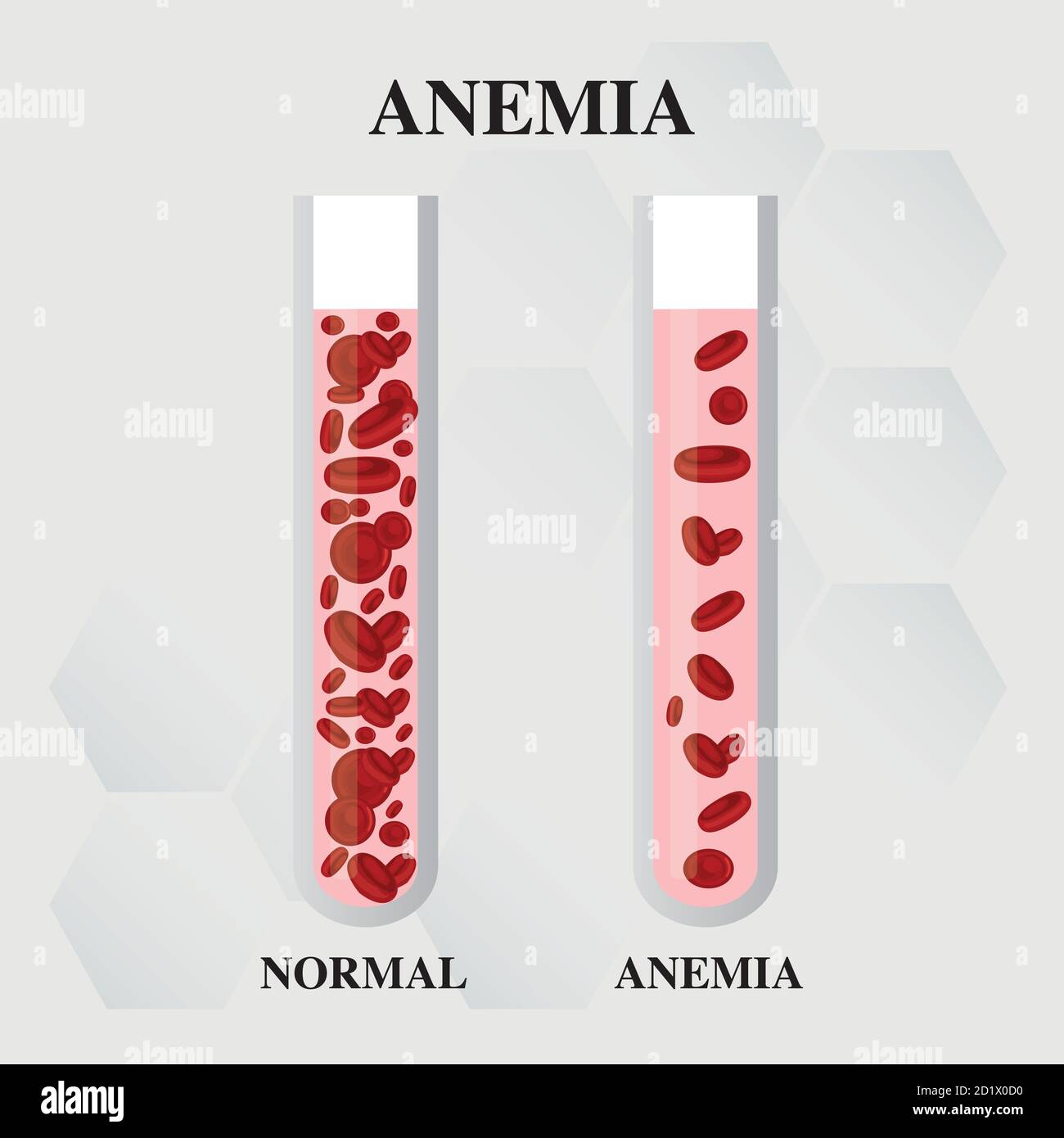 Anemia quantità di sangue rosso carenza di ferro anemia differenza di anemia quantità di globuli rossi e sintomi normali vettore illustrazione medica. Illustrazione Vettoriale