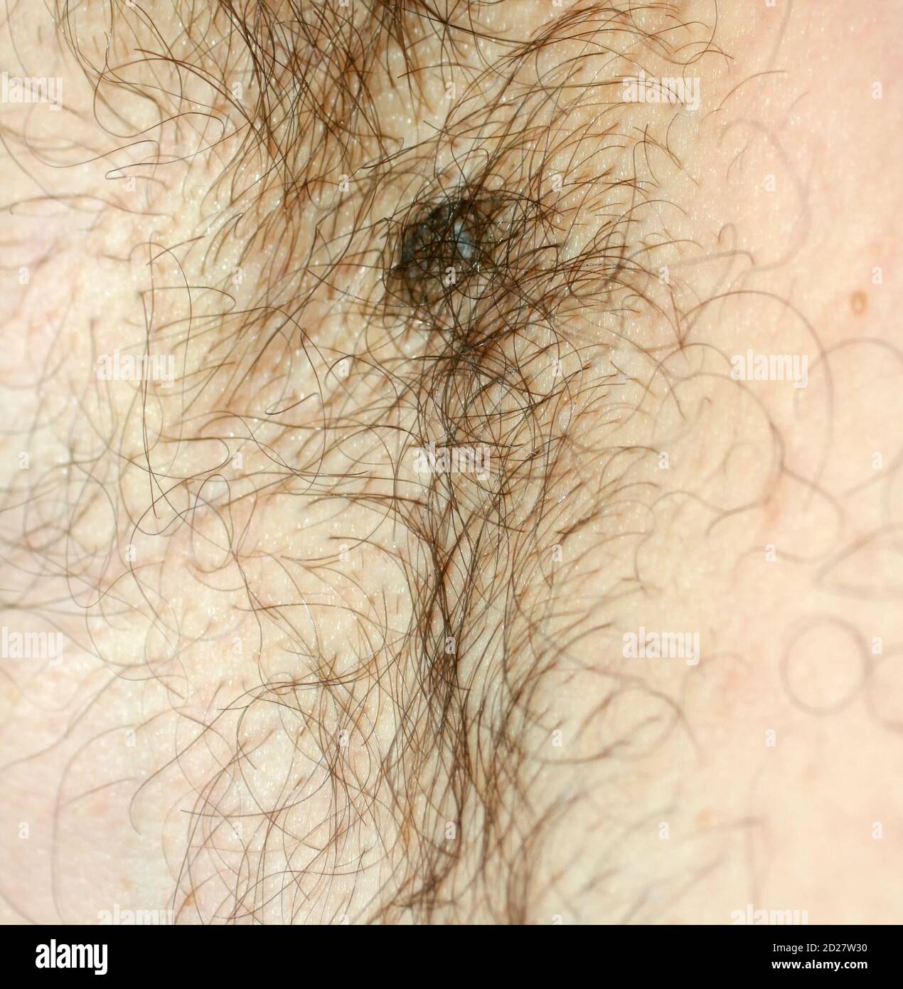 Macchia marrone sulla pelle. Macchie pigmentate e moli. Mole e capelli della pelle. Foto Stock