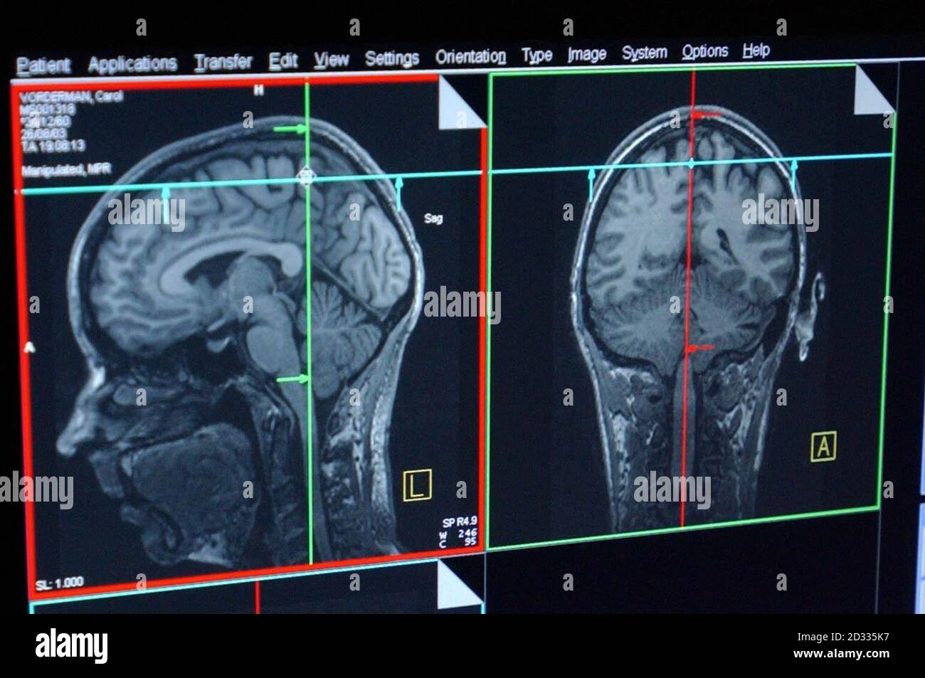 Questa è una sezione trasversale attraverso il cervello di Carol Vorderman - e ora i ricercatori vogliono scoprire perché ha una testa per le figure. Mentre alcune persone credono che il 95% della popolazione può essere buona a somme, il neurofisiologo Dr Mark Lythgoe ritiene che le persone possono essere nati con una capacità genetica per un'attitudine in scienza, matematica o arte e non è semplicemente pratica. Spiegherà le sue convinzioni in una serie di conferenze il prossimo mese a Londra, Bristol e Glasgow sponsorizzate da NESTA, National Endowment for Science, Technology and the Arts, come parte del suo sostegno alla creatività e all'innovazione nel Regno Unito e. Foto Stock