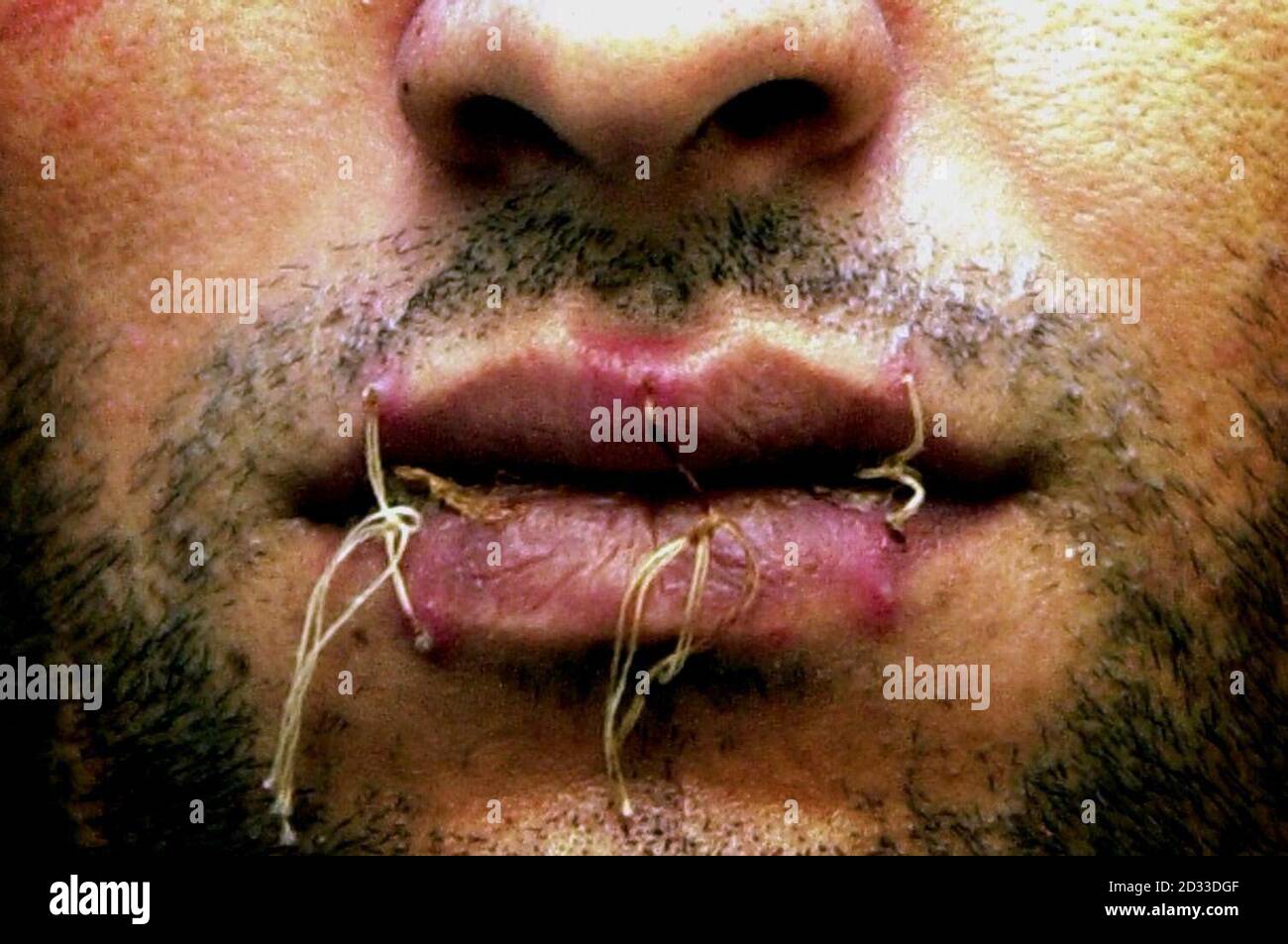 Tre richiedenti asilo provenienti dall’Iran hanno Unito le labbra per protesta. Faribarz Gravandi (nella foto), Faroq Haidari e Mokhtar Haydary sono stati rifiutati il permesso di rimanere nel Regno Unito, continuare la loro protesta contro lo sciopero della fame a Glasgow. 10/03/04: Faribarz Gravandi (nella foto) è uno dei tre richiedenti asilo iraniani che hanno cucito le labbra insieme per protestare contro i progetti di rimandare in Iran. Gravindi, 30, Mokhtar Haydary, 31, e Faroq Haidari, 32, sono stati in sciopero della fame a Glasgow da tre settimane e hanno detto che sono disposti a morire a meno che il governo non li conceda Foto Stock