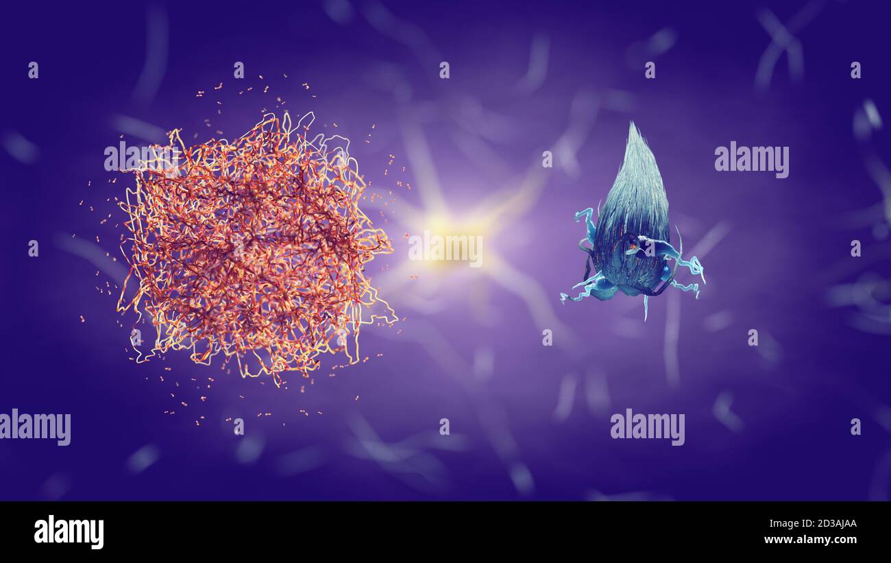 La proteina beta amiloide/placca amiloide e l'aggregato proteico Tau/groviglio neurofibrillare sono primari Marcatori per la malattia di Alzheimer Foto Stock
