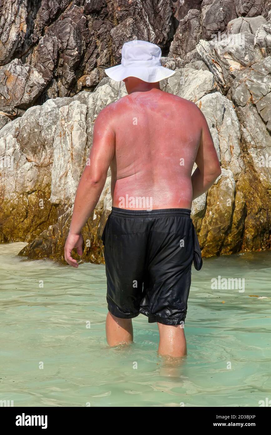 L'uomo che brucia si è cosparso di crema solare sullo sfondo di rocce. Foto Stock