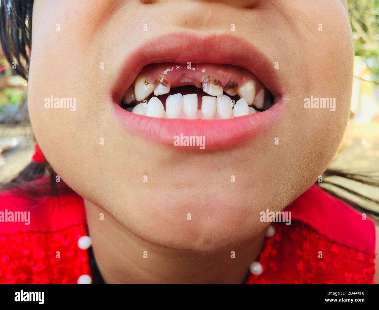Una ragazza con bocca aperta che mostra i suoi denti per il controllo La sua infezione della cavità e dentifricio.Decayed dente, problema dentale e malattia del dente.selettivo focu Foto Stock