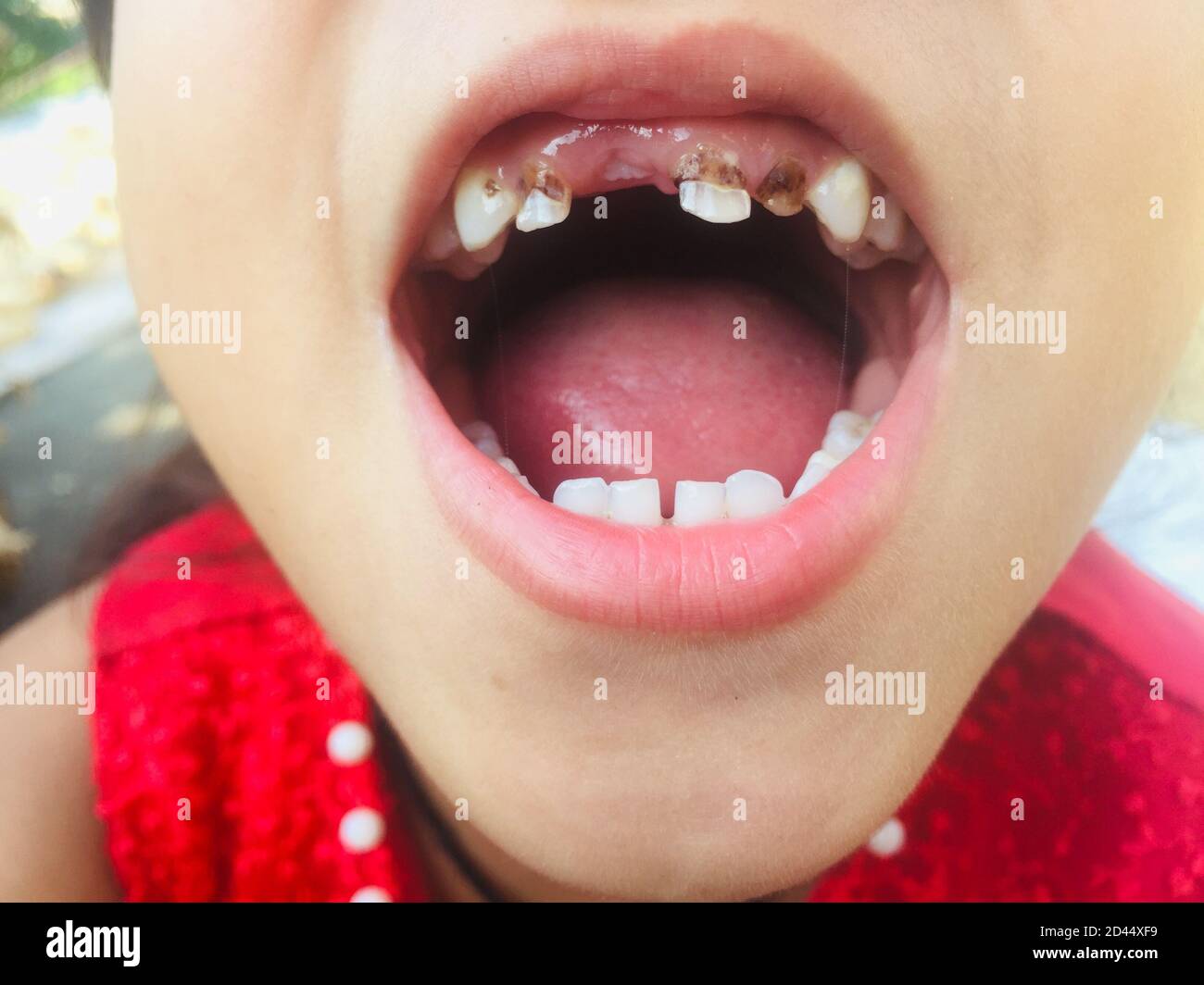 Una ragazza con bocca aperta che mostra i suoi denti per il controllo La sua infezione della cavità e dentifricio.Decayed dente, problema dentale e malattia del dente.selettivo focu Foto Stock