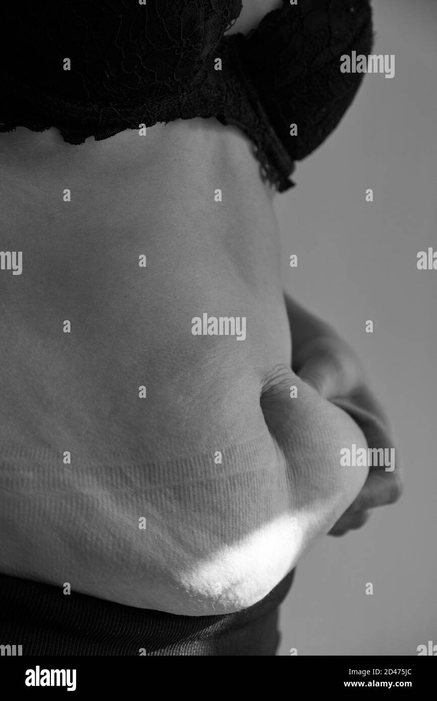 Segni di grasso e stiramento sulla pancia di una donna, obesità, primo piano, foto in bianco e nero. Foto Stock