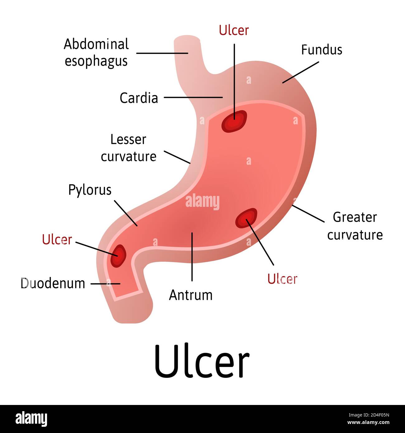 Ulcera peptica dello stomaco, anatomia colorata microscopica su sfondo bianco. Le illustrazioni vettoriali mediche con tutte le parti interne sono contrassegnate con Illustrazione Vettoriale