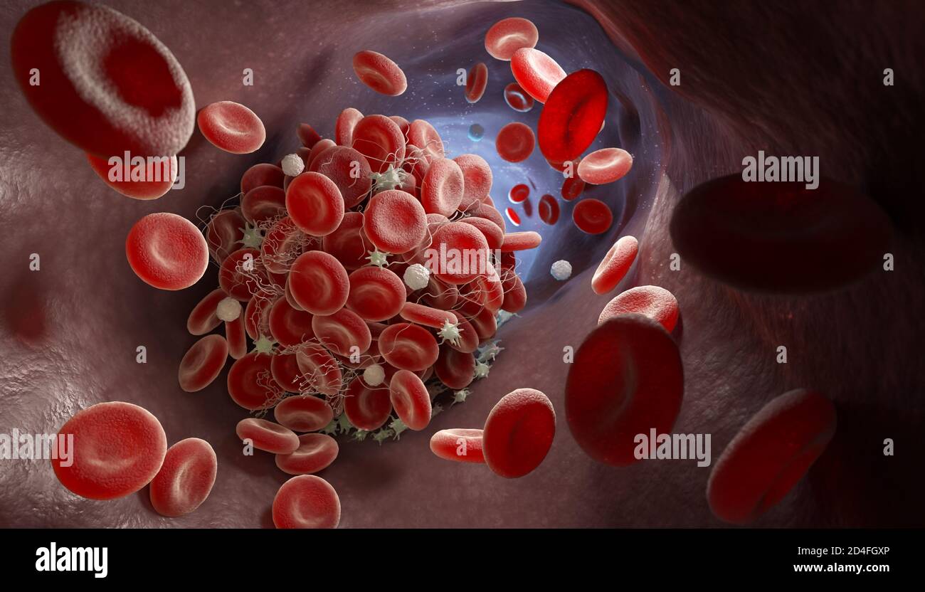 Rappresentazione di un coagulo di sangue formando all'interno di un vaso sanguigno. 3D illustrazione Foto Stock