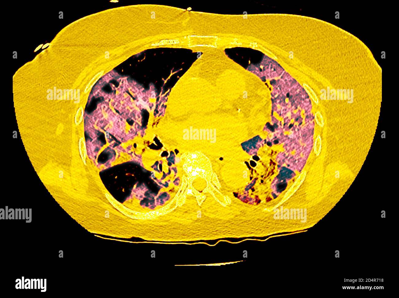 Polmoni affetti da coronavirus Covid-19, tomografia (TC). Foto Stock