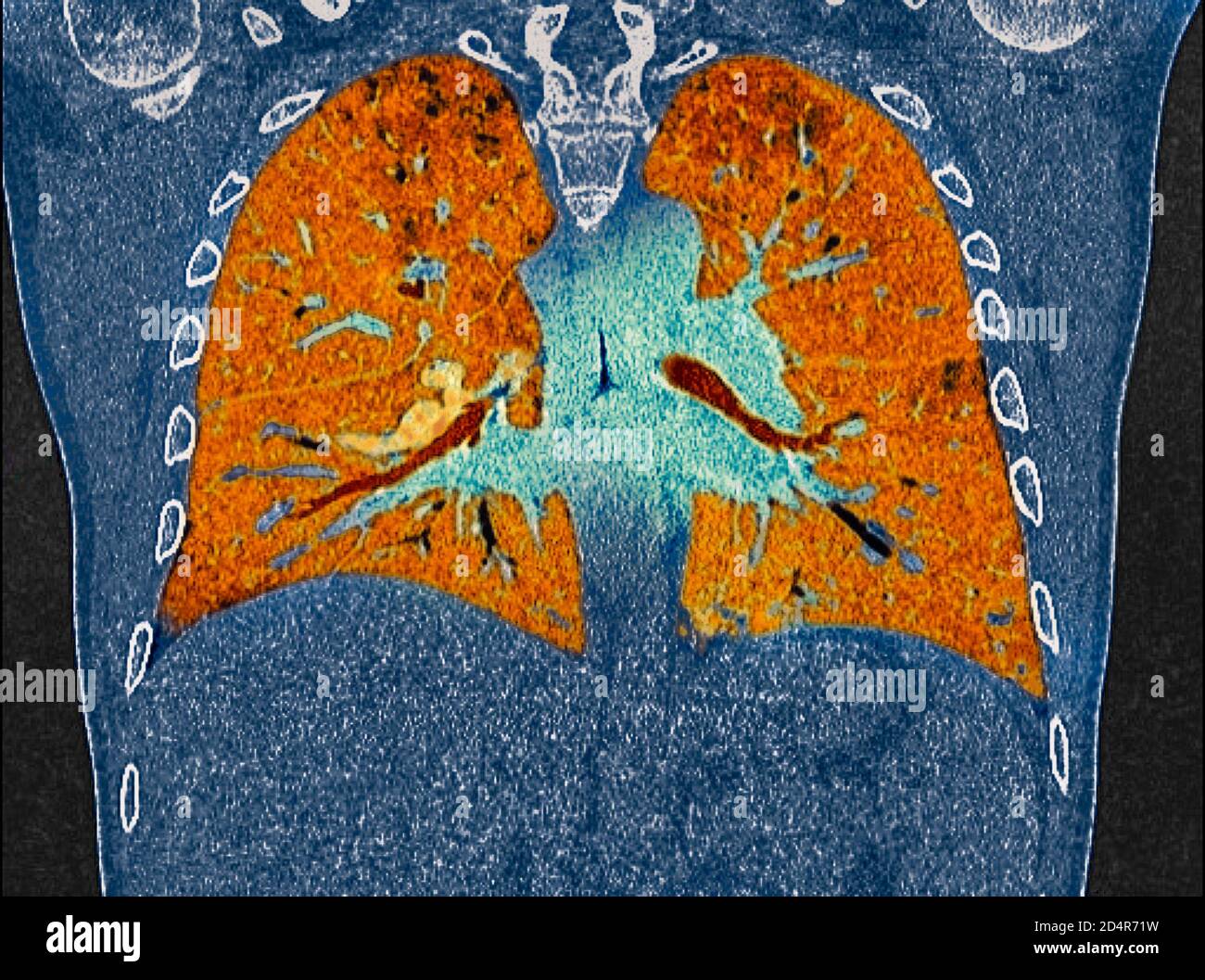 Polmoni affetti da coronavirus Covid-19, tomografia (TC). Foto Stock
