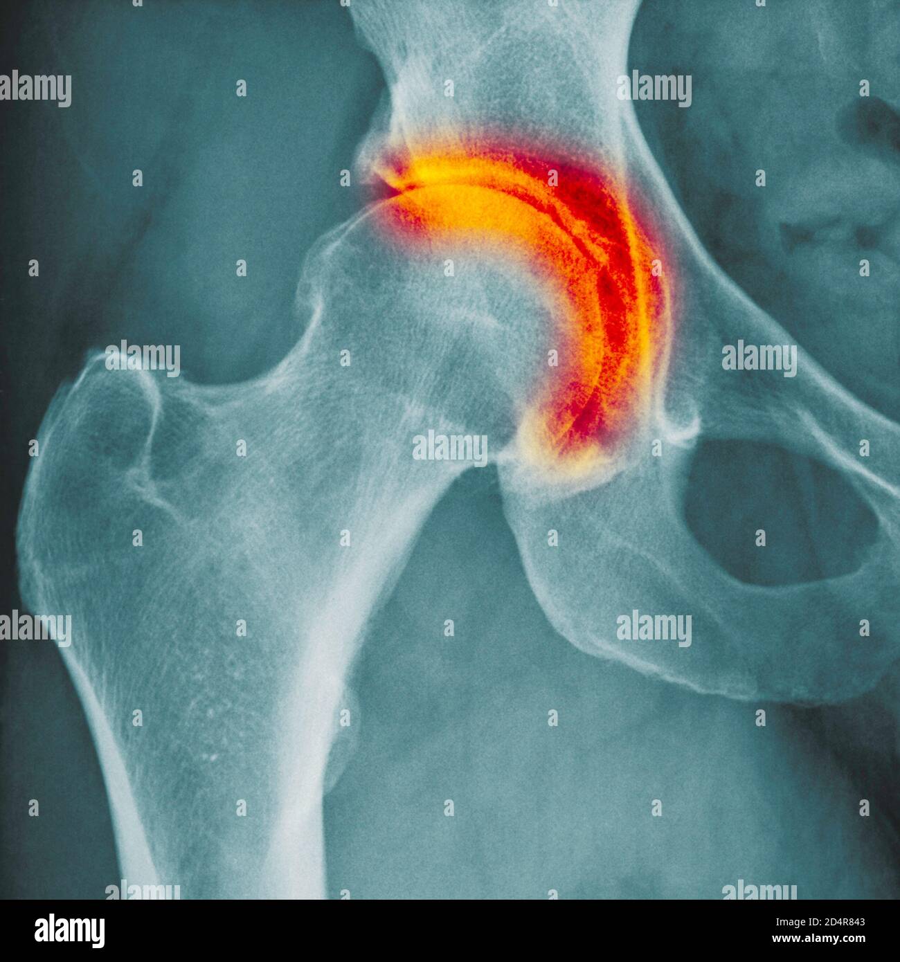 Radiografia che mostra l'artrite dell'anca, l'artrite è una malattia articolare che può causare distruzione della cartilagine, erosioni ossee, e infiammazione dei tendini. Foto Stock