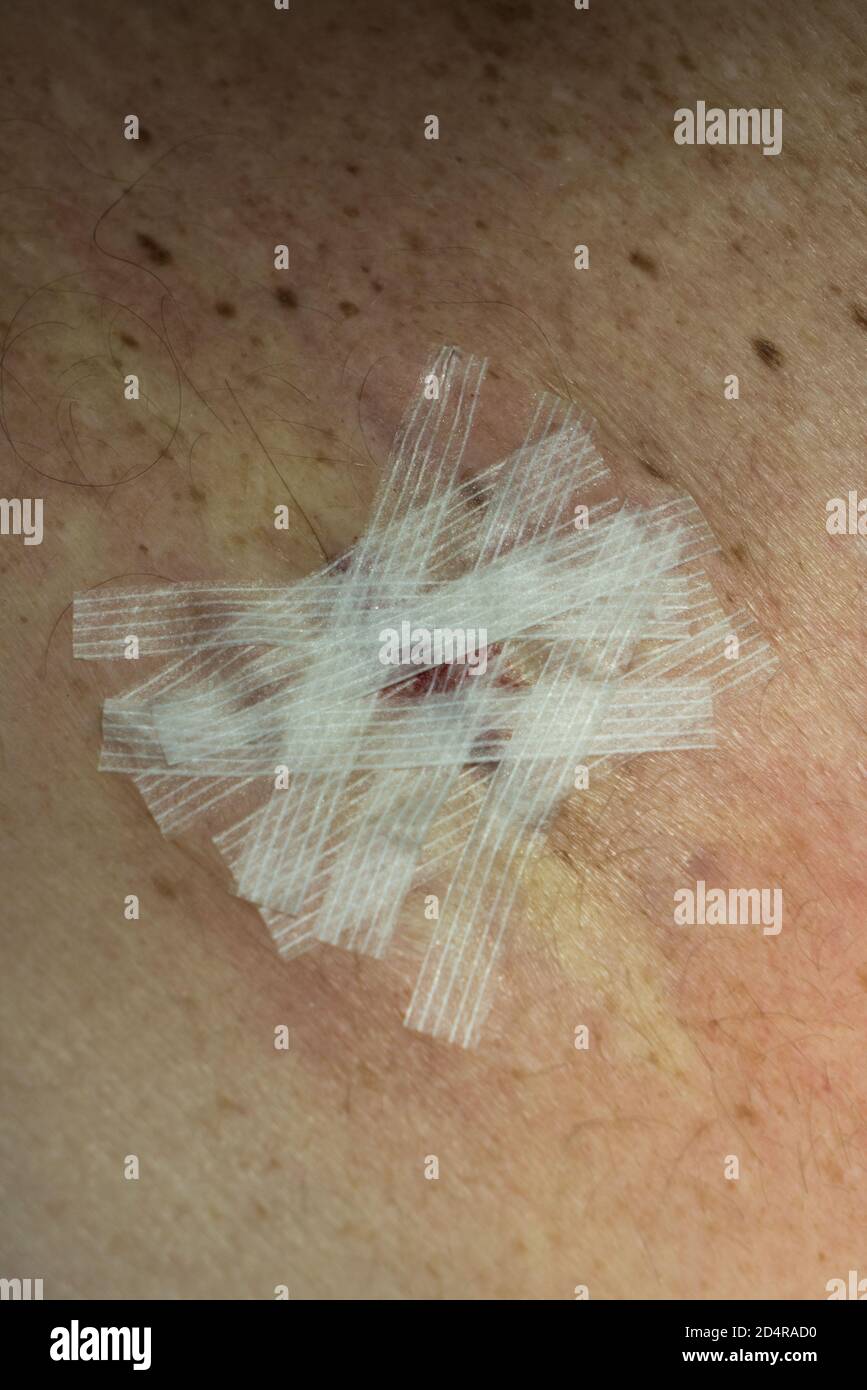 Primo piano di una cicatrice, dopo la rimozione (escissione) di un melanoma a diffusione superficiale (SSM) cancro della pelle. Foto Stock