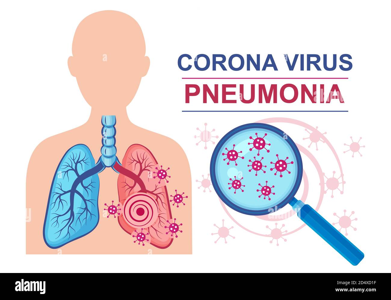 Virus corona malattia polmonite segno vettore. Infezione polmonare. Normale e affetta da malattia polmonare.trattamento infiammazione apparato respiratorio umano. Illustrazione Vettoriale