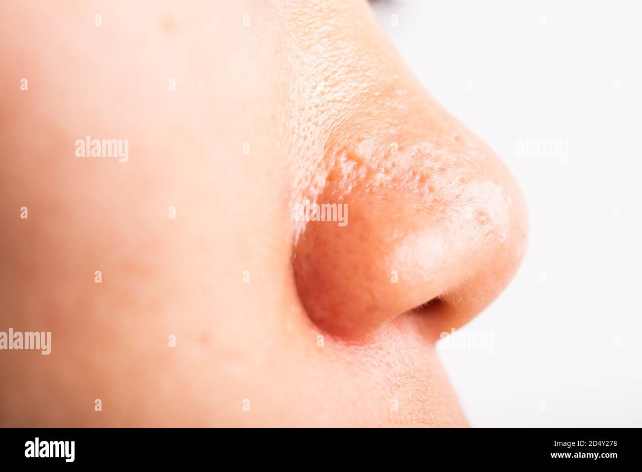 Closeup Asian giovane donna grandi pori hanno fleckles guancia oleosa, acne pimple sul naso, studio girato isolato su sfondo bianco, Healthcare bellezza pelle Foto Stock