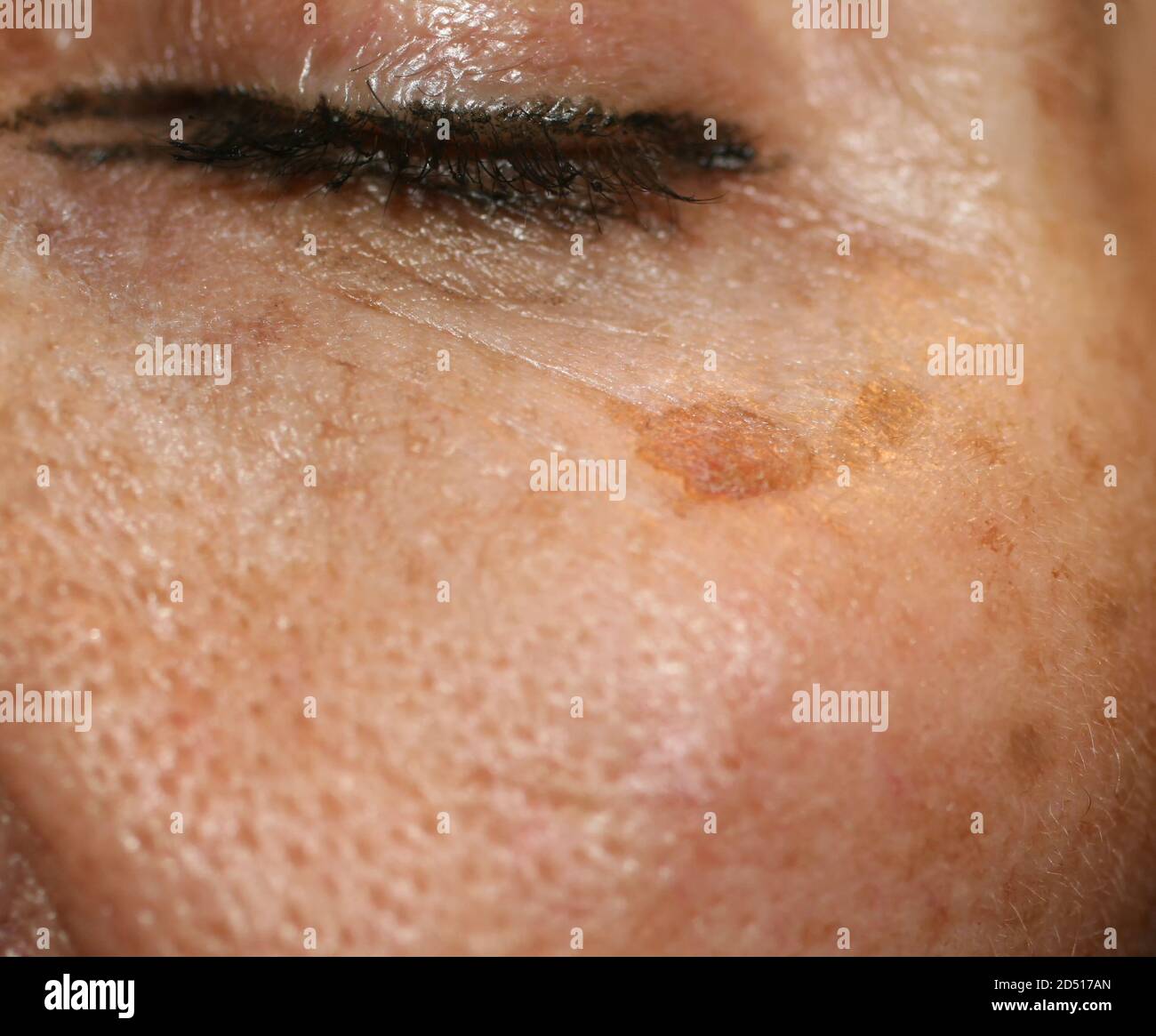 Macchia marrone sulla pelle del viso. Pigmentazione sulla pelle Foto stock  - Alamy