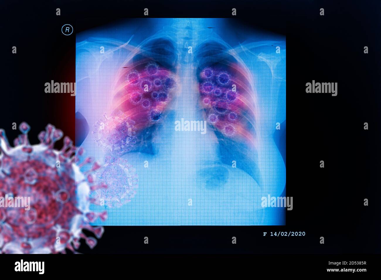 Malattia del coronavirus infezione del virus COVID-19 nei polmoni umani, nuova infezione del virus della corona o COVID (nuova malattia di Coronavirus 2019, COVID-19, nCoV, SAR Foto Stock