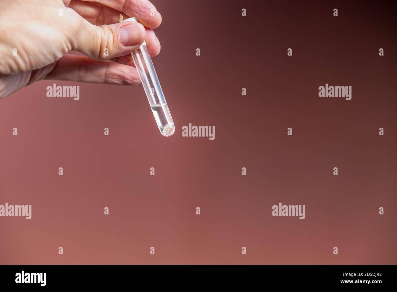 Carcinoma basocellulare nel campionamento cutaneo della copertura cutanea la schiena per l'esame istopatologico immerso in formalina in a. provetta per analisi Foto Stock