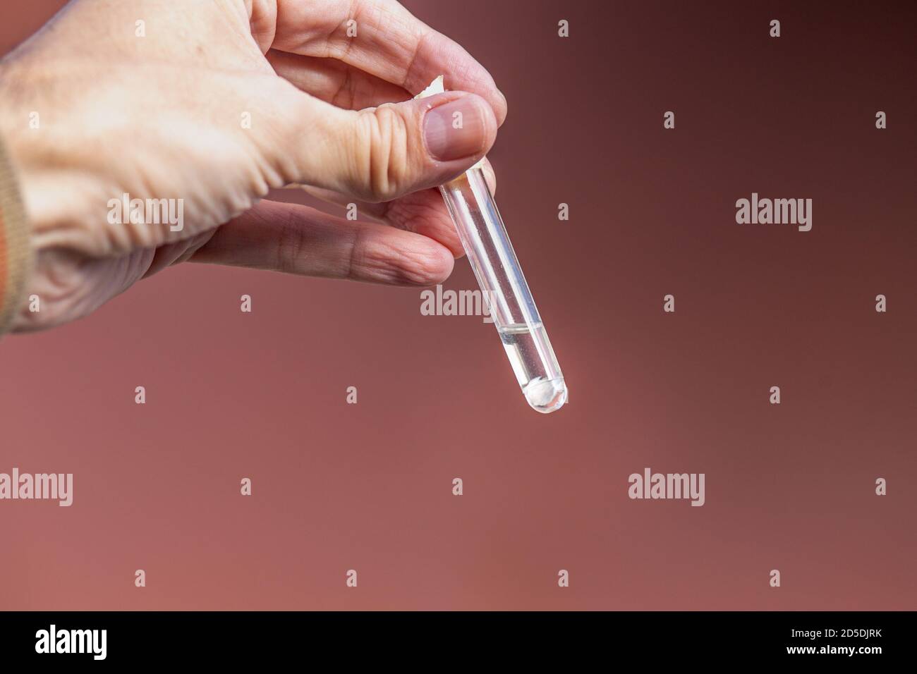 Carcinoma basocellulare nel campionamento cutaneo della copertura cutanea la schiena per l'esame istopatologico immerso in formalina in a. provetta per analisi Foto Stock