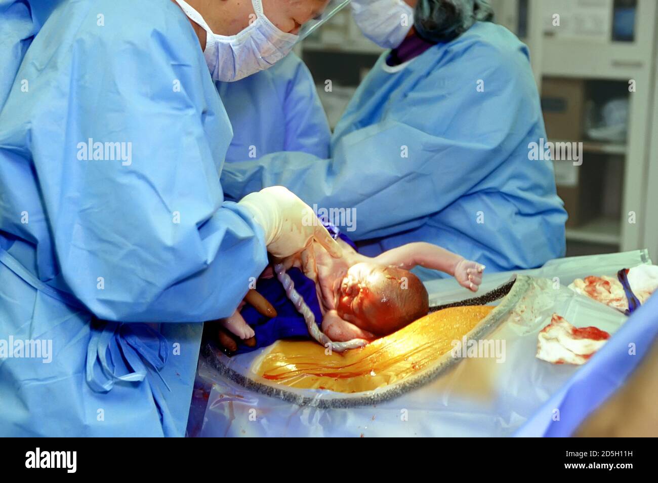I medici in una sala operatoria eseguono una nascita Cesareo il una donna incinta Foto Stock