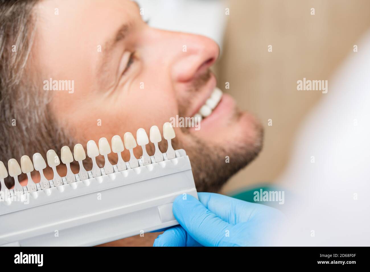 Il dentista utilizza un campione di colore dei denti della tavolozza per determinare l'ombra dei denti maschi del paziente. Lo stomatologo userà il colore dei denti per fare veneer, corone, Foto Stock