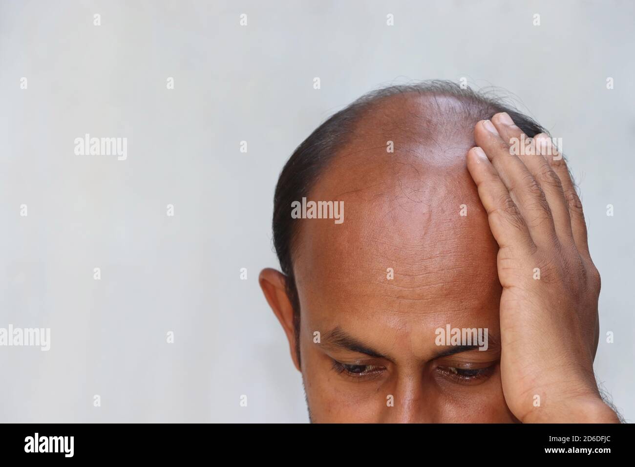 L'uomo asiatico della testa di mezzo calvo sopra ulteriore perdita dei capelli problema isolato su sfondo bianco dello spazio di copia Foto Stock