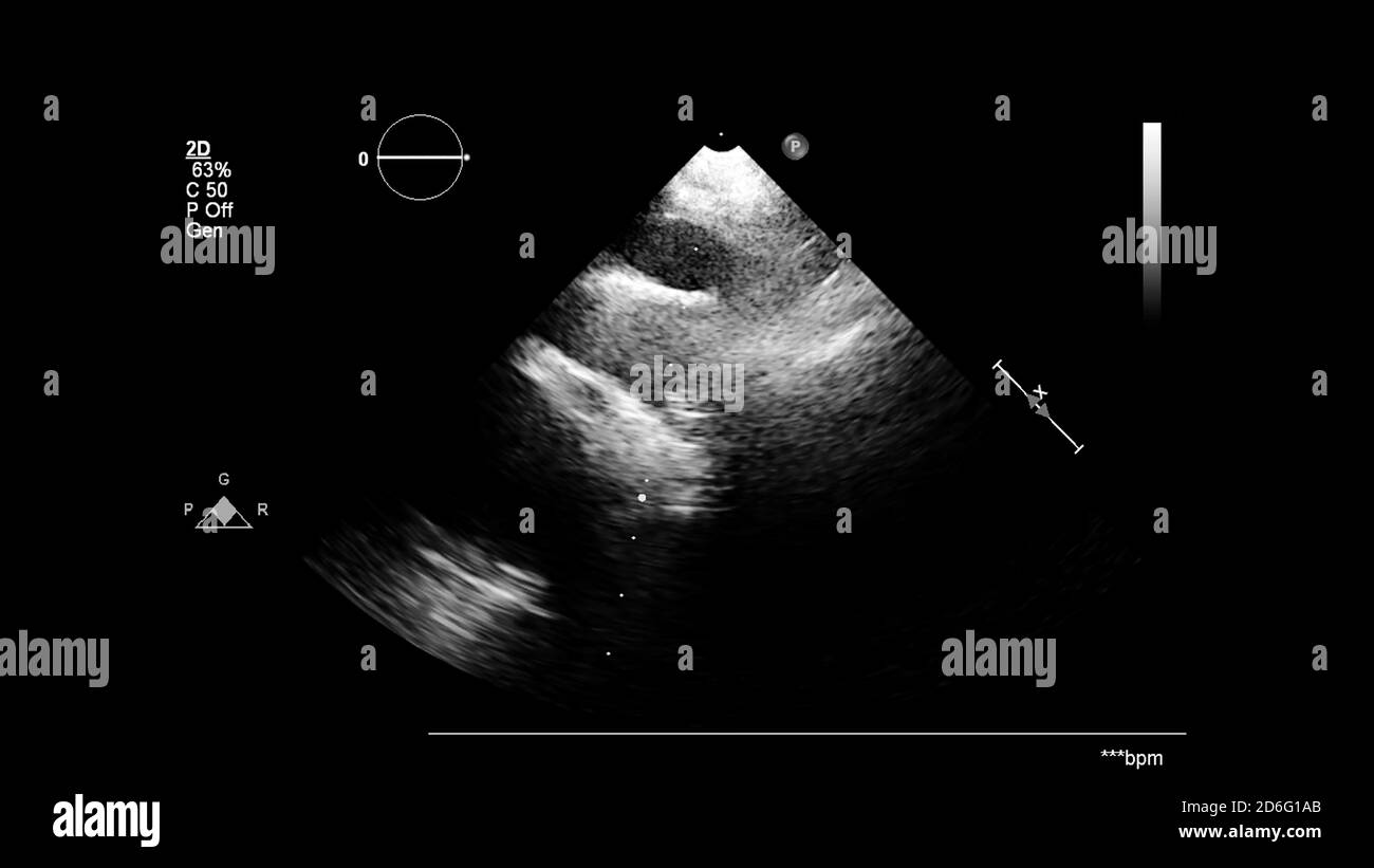 Immagine del cuore in modalità scala di grigi durante l'ecografia transesofagea. Foto Stock