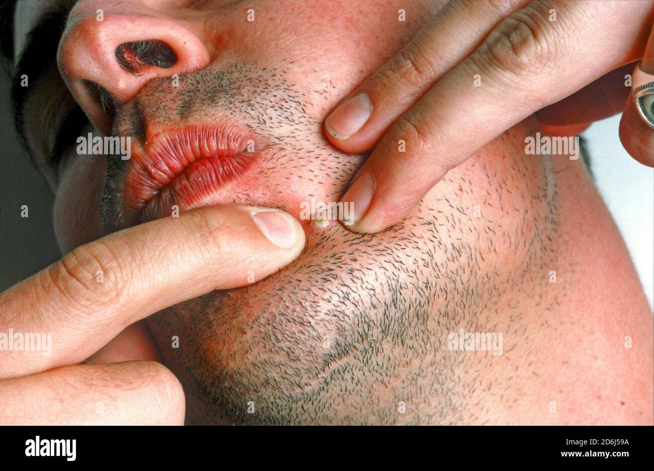 L'uomo esprime un pimple, disgustoso, pelle, Berlino, Germania Foto Stock