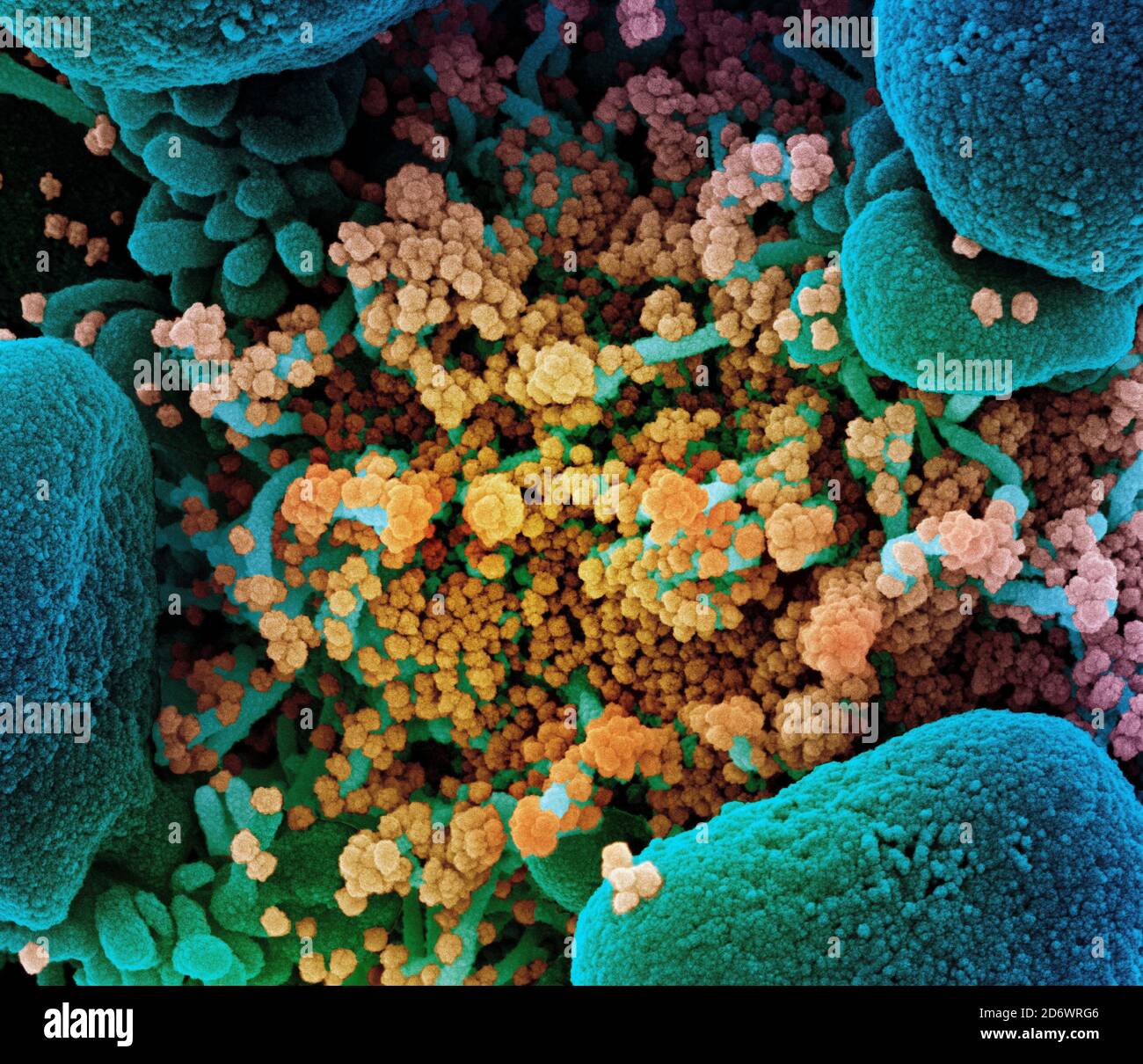 Micrografia elettronica a scansione colorata di una cellula apoptotica (blu) fortemente infettata con particelle di virus SARS-COV-2 (giallo), isolata da un paziente Foto Stock