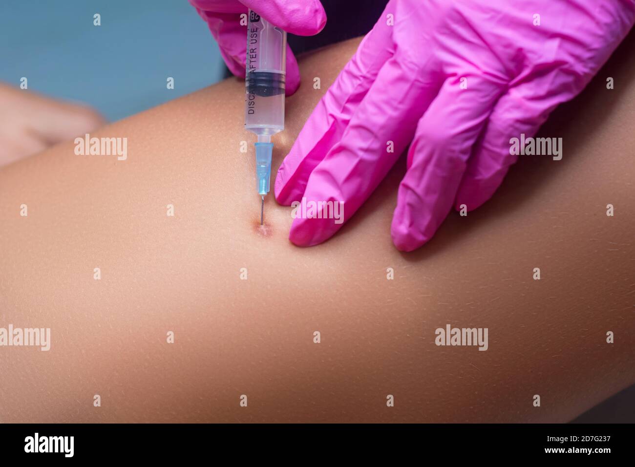 Rimozione delle cicatrici keloid. L'estetista dà un'iniezione per rinnovare la pelle. Foto Stock