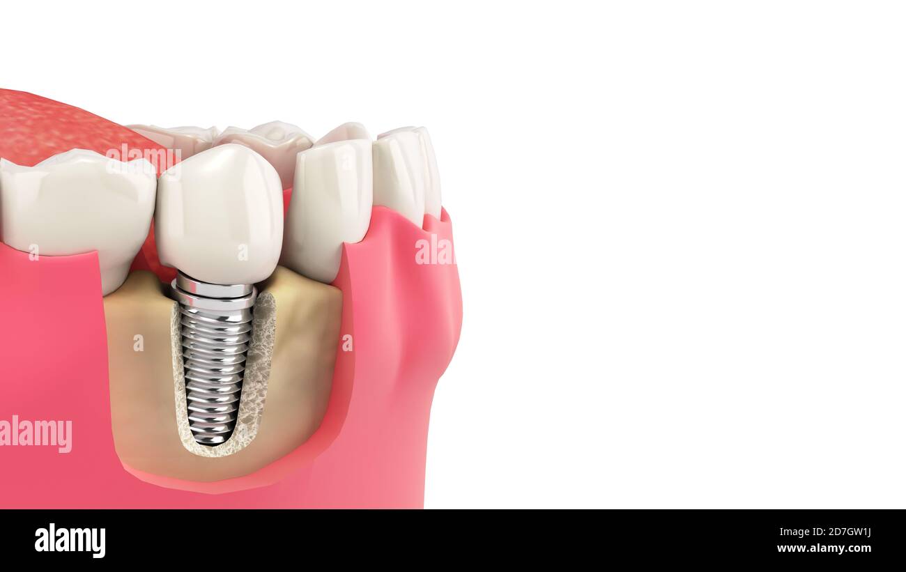 Dente umano singolo impianto concetto dentale denti umani o dentellature rendering 3d su bianco Foto Stock