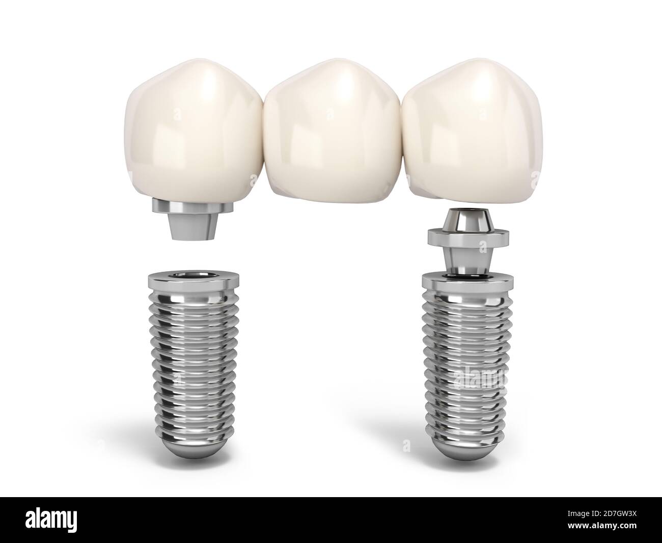 Dente umano impianto multitooth concetto dentale denti umani o protesi dentarie rendering 3d multitooth su bianco Foto Stock