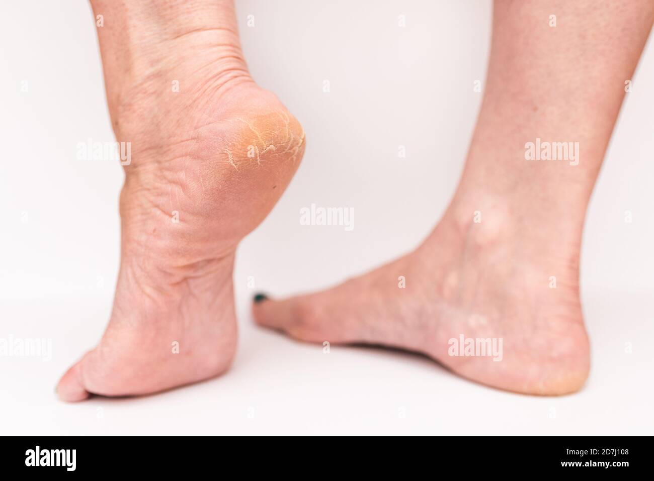 Closeup crepe su donna Heels isolato bianco background.Health concetto. Foto Stock