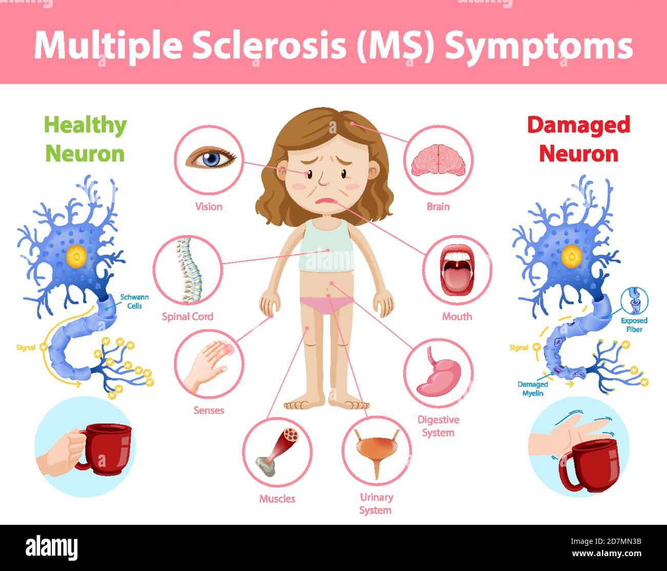 Informazioni sui sintomi della sclerosi multipla (MS) illustrazione infografica Illustrazione Vettoriale