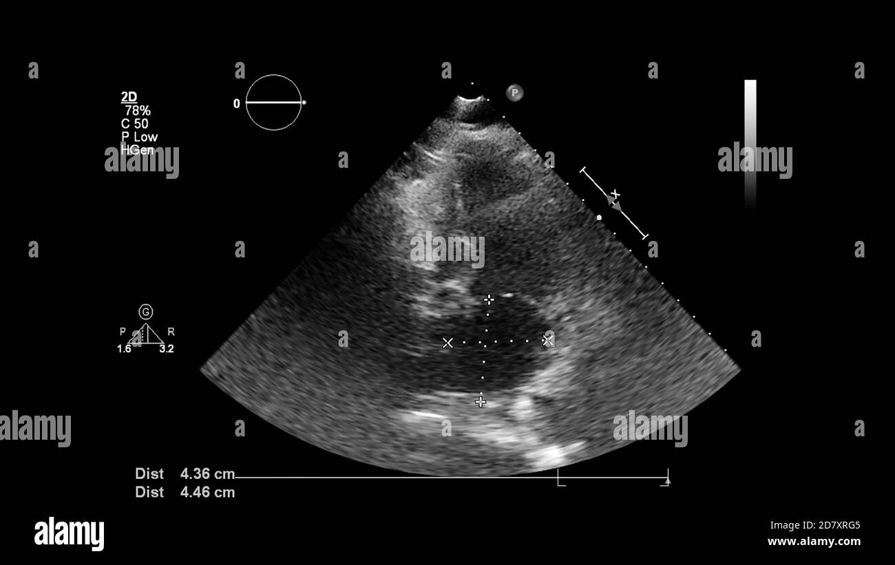 Ecocardiogramma transtoracico immagini e fotografie stock ad alta  risoluzione - Alamy