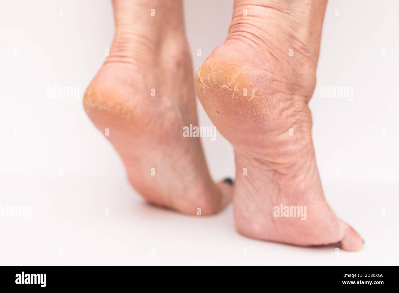 Closeup crepe su donna Heels isolato bianco background.Health concetto. Foto Stock