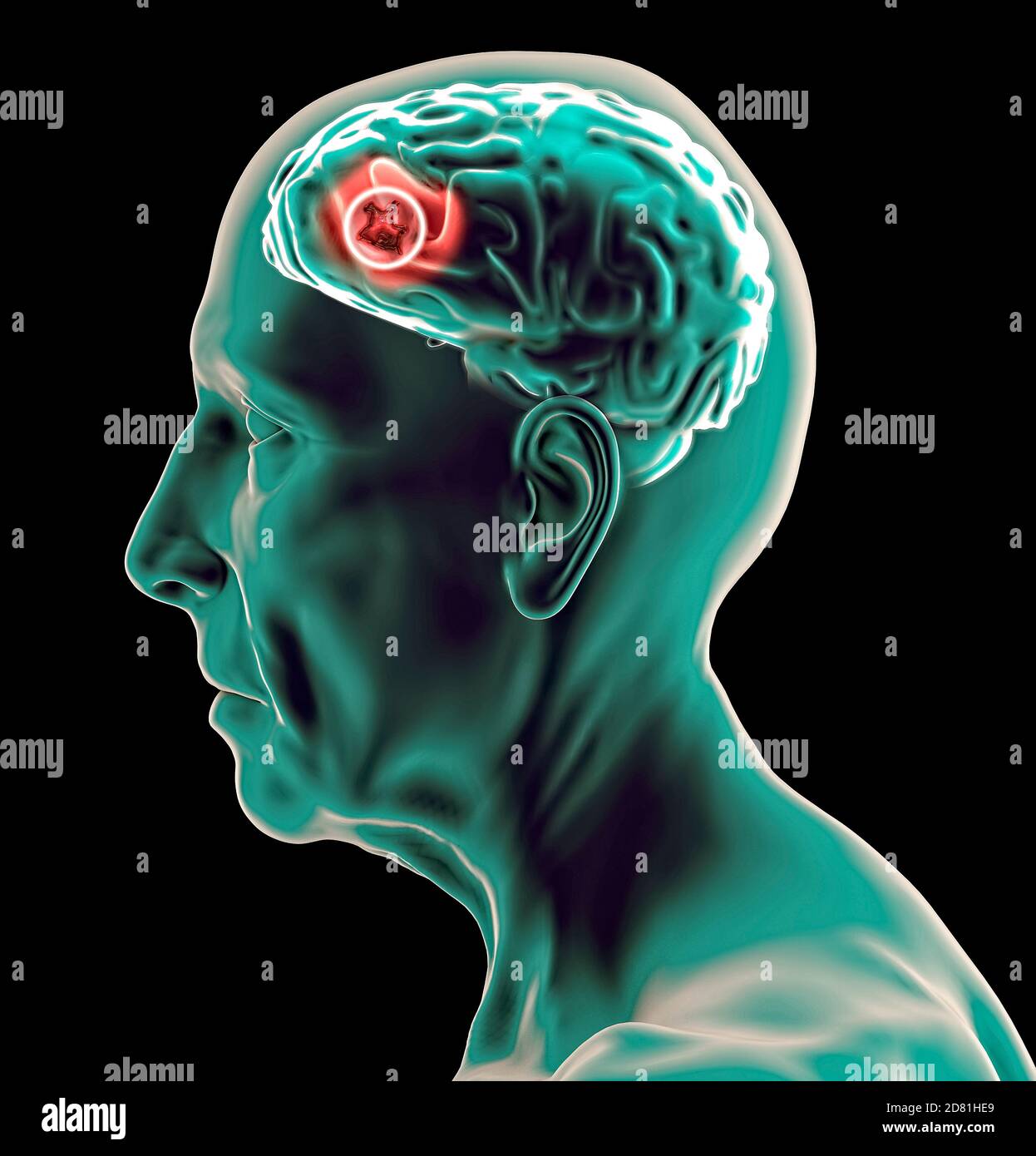 Vista laterale di un cervello di un uomo anziano. Tumore. Neuroni e sinapsi. Malattie degenerative, Parkinson, Alzheimer. rendering 3d Foto Stock