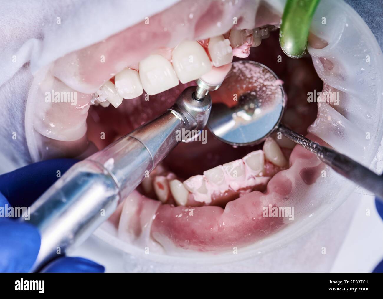 Vista ravvicinata dei denti di pulizia del paziente con divaricatore guancia in bocca e staffe sui denti con l'aiuto di spazzola per denti, spazzola meccanica, specchio ed espulsore di saliva. Concetto di procedure odontoiatriche Foto Stock