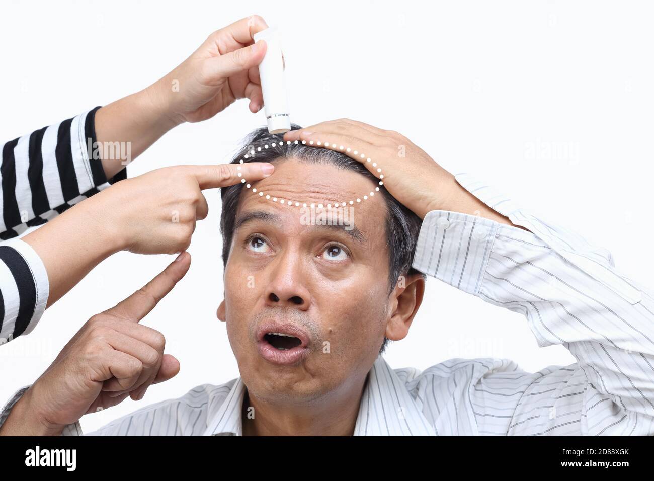 Calvizie (perdita di capelli) ha portato alla crisi di metà vita Foto Stock