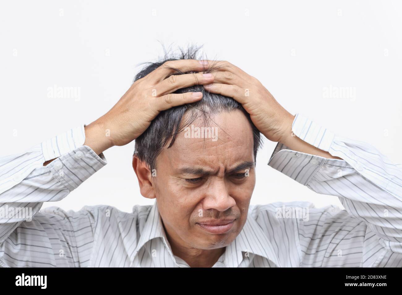 Calvizie (perdita di capelli) ha portato alla crisi di metà vita Foto Stock