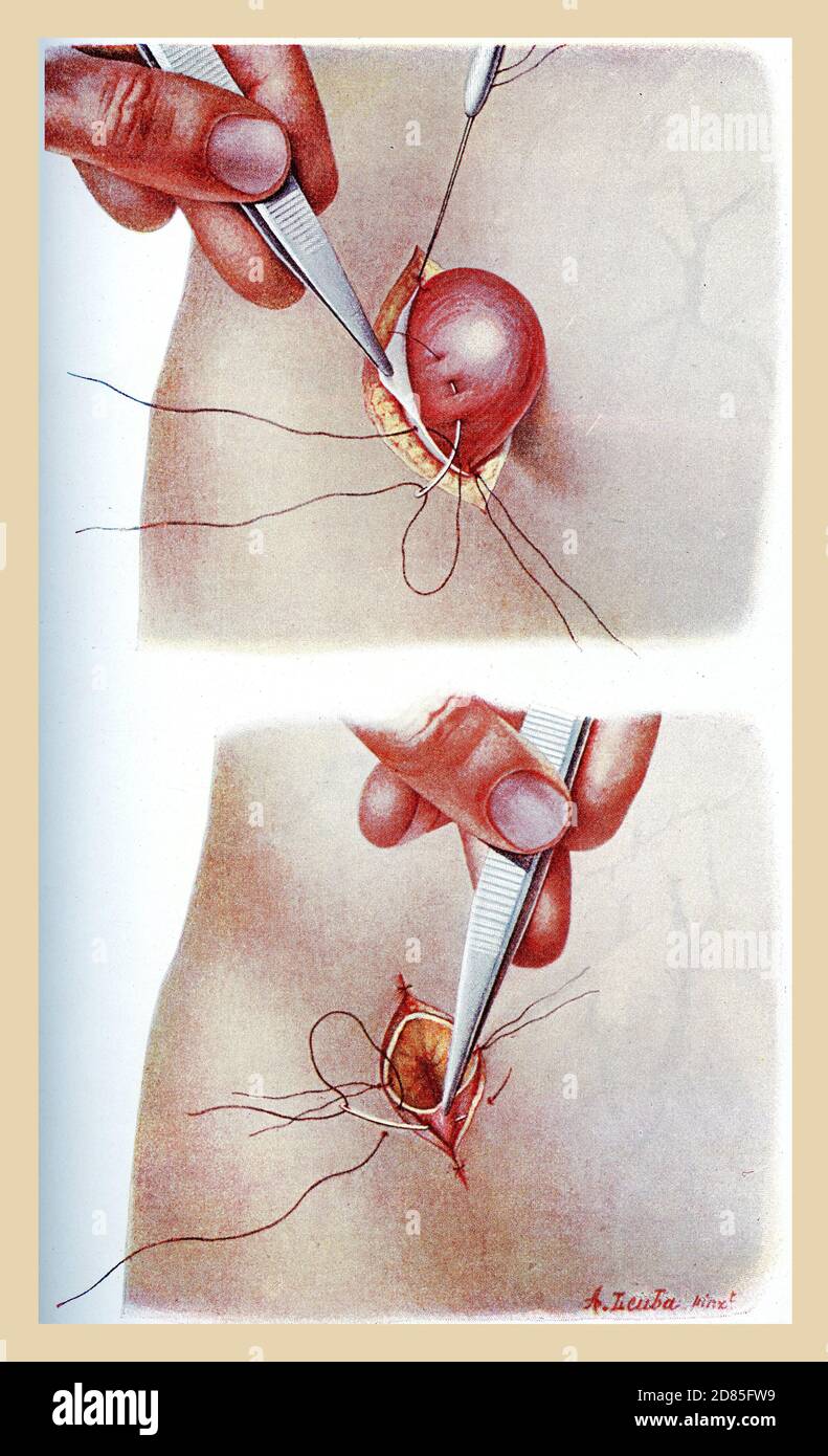 Sanità e medicina vintage illustrazione del colore: Enterostomia, operazione chirurgica per creare un'apertura durevole (stoma) attraverso la parete addominale in un segmento dell'intestino Foto Stock
