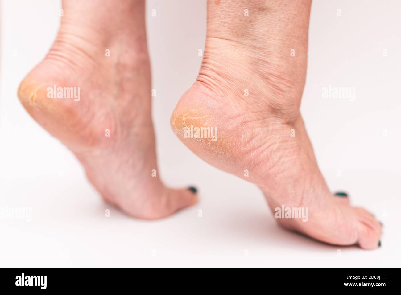 Closeup crepe su donna Heels isolato bianco background.Health concetto. Foto Stock