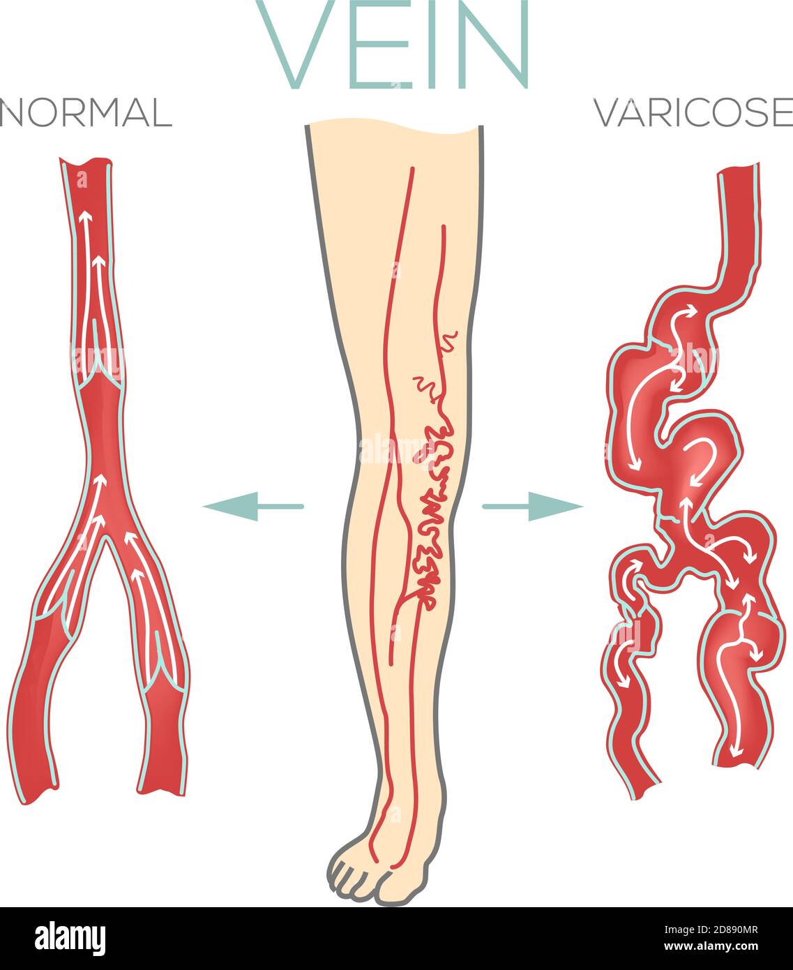 Vene varicose, grandi, gonfie sulle gambe e sui piedi. Le valvole non funzionano, il sangue non scorre in modo efficace. Illustrazione vettoriale dello schema medico. Illustrazione Vettoriale