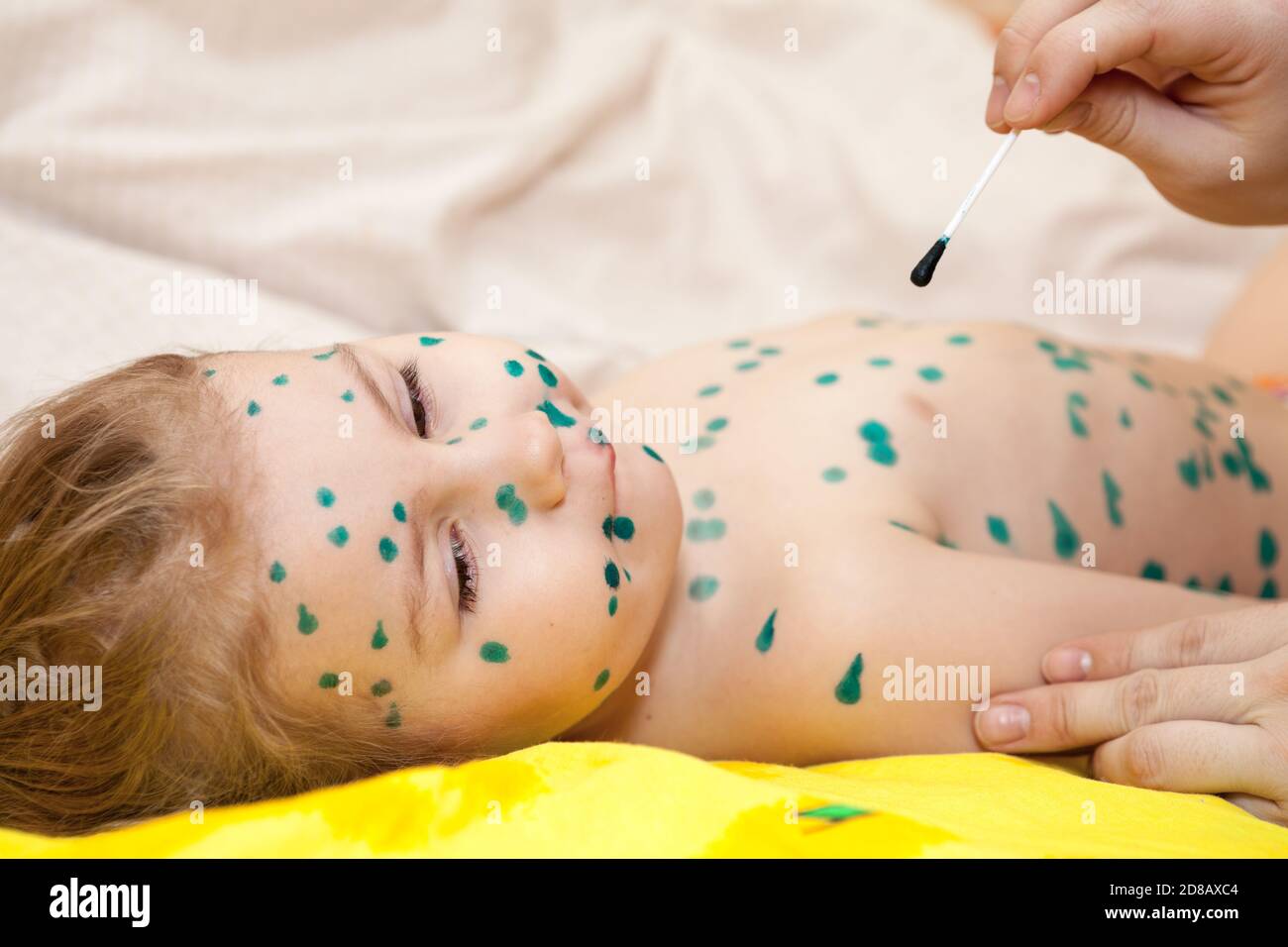 Trattamento domestico della varicella. Bambina con varicella. Una soluzione antisettica per l'eruzione cutanea è verde Foto Stock
