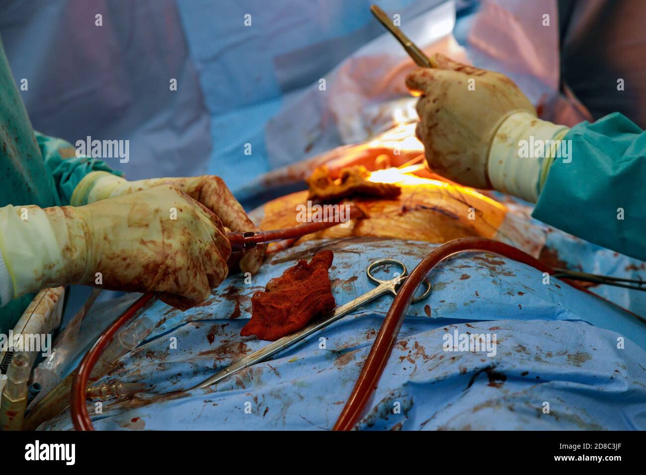 Battere il cuore umano nel petto aperto durante l'intervento chirurgico durante la chirurgia cardiaca Foto Stock