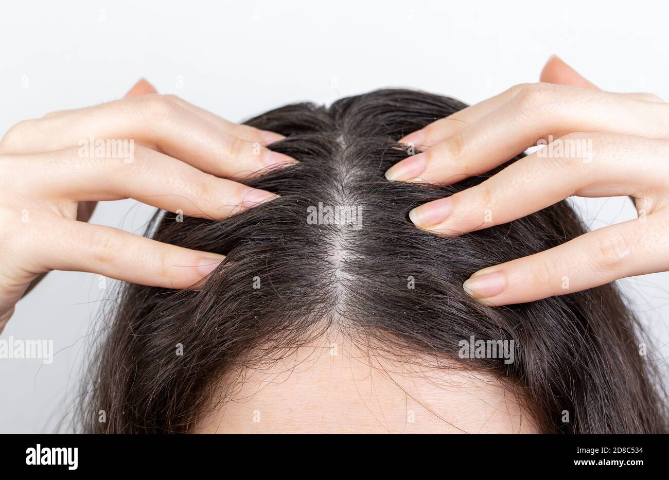 Forfora e problemi ai capelli. La donna graffia il cuoio capelluto con le  mani, mostrando i capelli scuri con forfora. Sfondo bianco Foto stock -  Alamy