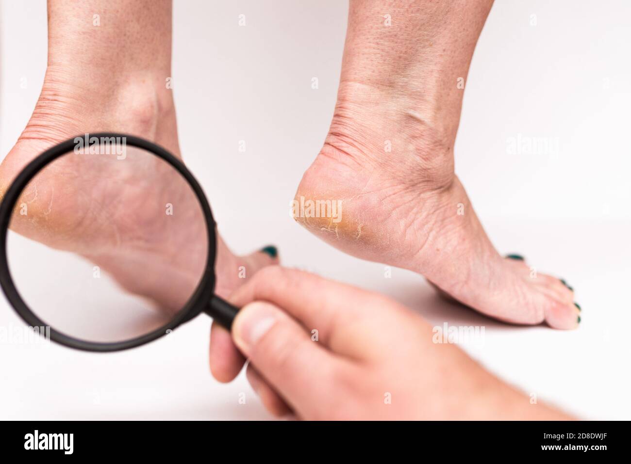 Closeup donna tacchi altamente asciutto su uno sfondo bianco attraverso una lente d'ingrandimento.la mano dei medici verifica quanto è incrinato la pelle. Foto Stock